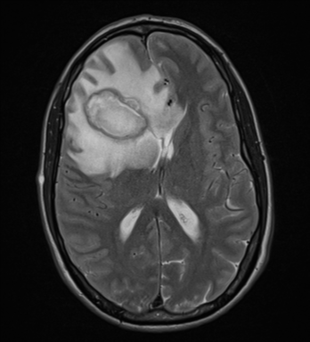 File:Cerebral abscess (Radiopaedia 60342-68009 Axial T2 20).png
