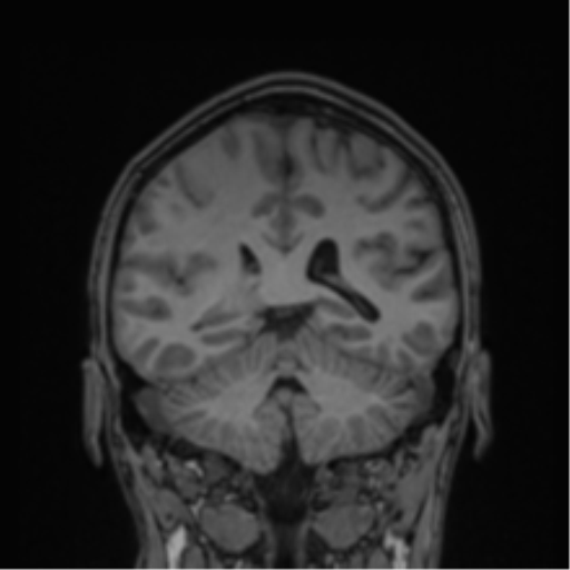 Cerebral abscess (Radiopaedia 60342-68009 Coronal T1 16).png