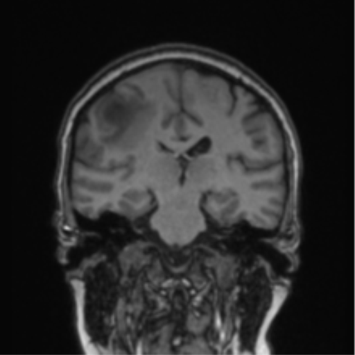 Cerebral abscess from pulmonary arteriovenous malformation (Radiopaedia 86275-102291 Coronal T1 42).png