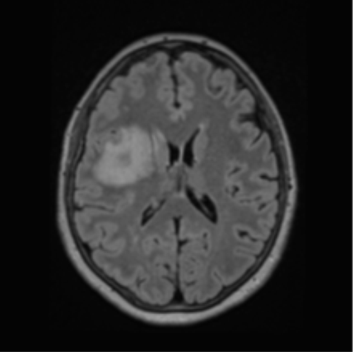 File:Cerebral abscess from pulmonary arteriovenous malformation (Radiopaedia 86275-102291 J 45).png