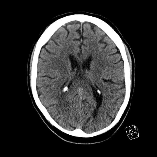 Cerebral abscess with ventriculitis (Radiopaedia 78965-91876 Axial non-contrast 29).jpg