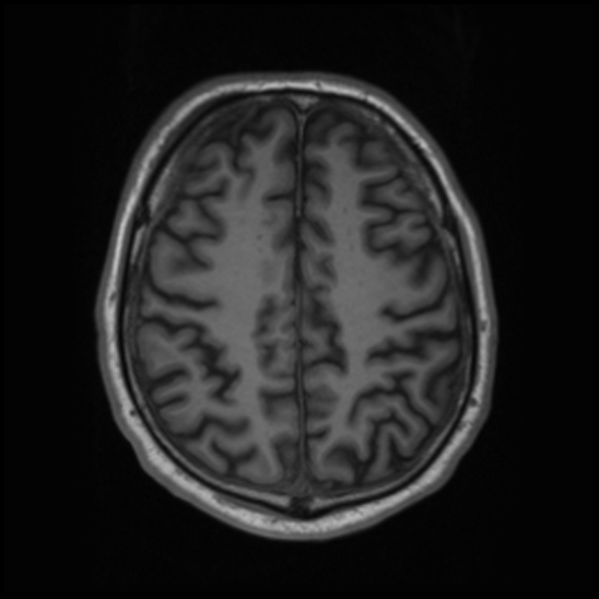 File:Cerebral abscess with ventriculitis (Radiopaedia 78965-91878 Axial T1 36).jpg