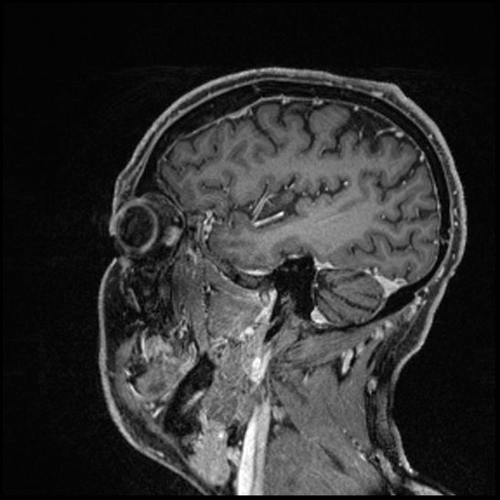 Cerebral abscess with ventriculitis (Radiopaedia 78965-91878 Sagittal T1 C+ 138).jpg