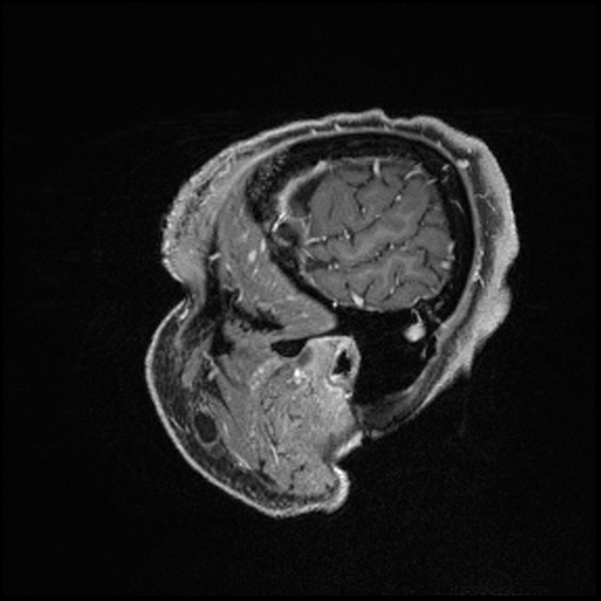 Cerebral abscess with ventriculitis (Radiopaedia 78965-91878 Sagittal T1 C+ 24).jpg
