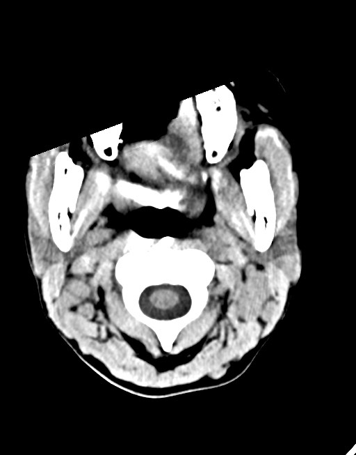 Cerebral abscesses (Radiopaedia 70458-80568 Axial non-contrast 3).jpg