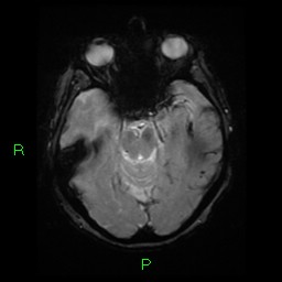 File:Cerebral amyloid angiopathy-associated lobar intracerebral hemorrhage (Radiopaedia 58376-65512 Axial Gradient Echo 17).jpg