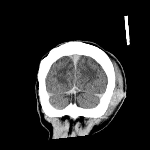File:Cerebral amyloid angiopathy-related inflammation (Radiopaedia 74836-85848 Coronal non-contrast 64).jpg