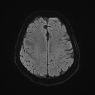 Cerebral amyloid angiopathy-related inflammation (Radiopaedia 74836-85849 Axial DWI 51).jpg