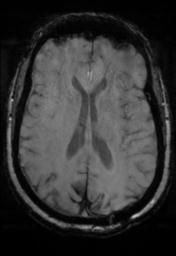File:Cerebral amyloid angiopathy (Radiopaedia 29129-29518 Axial SWI Magnitude 21).jpg