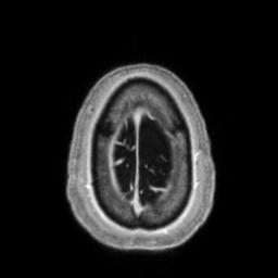 Cerebral amyloid angiopathy (Radiopaedia 29129-29518 Axial T1 C+ 140).jpg