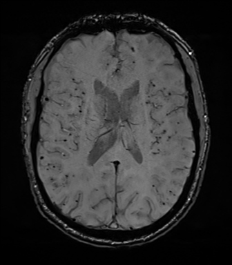 File:Cerebral amyloid angiopathy (Radiopaedia 46082-50433 Axial SWI 49).png