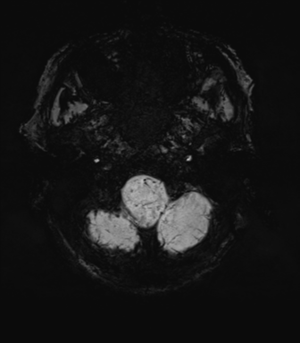 File:Cerebral amyloid angiopathy (Radiopaedia 46082-50433 Axial SWI MIP 7).png