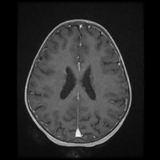 Cerebral and spinal tuberculosis (Radiopaedia 90489-107837 Axial T1 C+ 127).jpg
