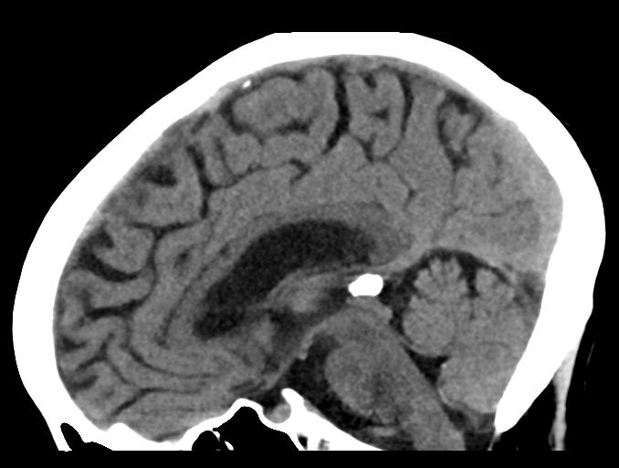 File:Cerebral aneurysm with rupture (Radiopaedia 29933-30457 B 16).jpg