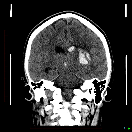 Cerebral arteriovenous malformation (AVM) (Radiopaedia 78162-90706 Coronal non-contrast 58).jpg
