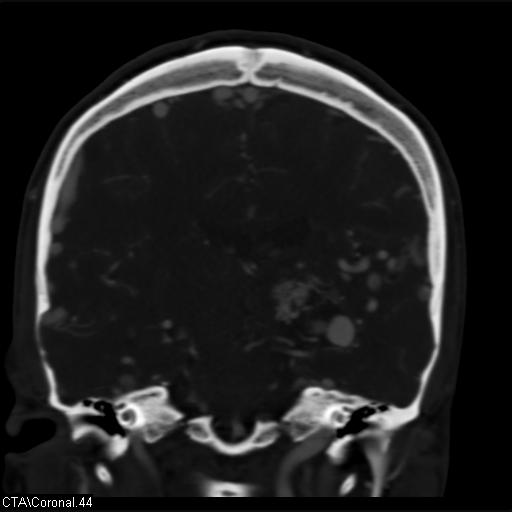 Cerebral arteriovenous malformation (Radiopaedia 28518-28759 C 44).jpg