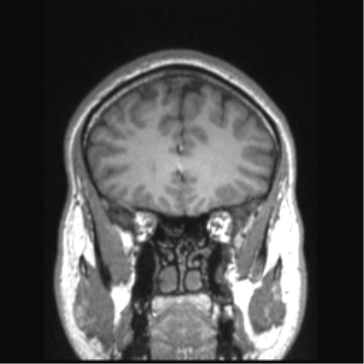 Cerebral arteriovenous malformation (Radiopaedia 39259-41506 Coronal T1 69).png