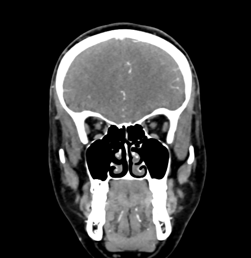 Cerebral arteriovenous malformation (Radiopaedia 73830-84645 C 26).jpg
