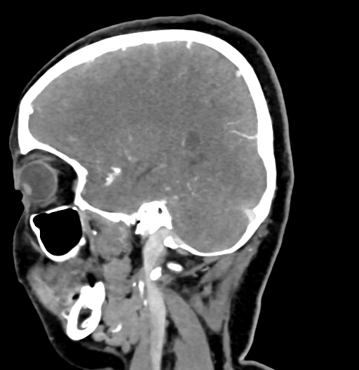 Cerebral arteriovenous malformation (Radiopaedia 73830-84645 D 29).jpg
