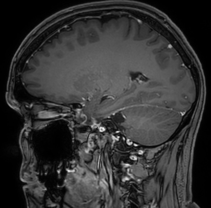 Cerebral arteriovenous malformation (Radiopaedia 74411-85654 Sagittal T1 C+ 47).jpg
