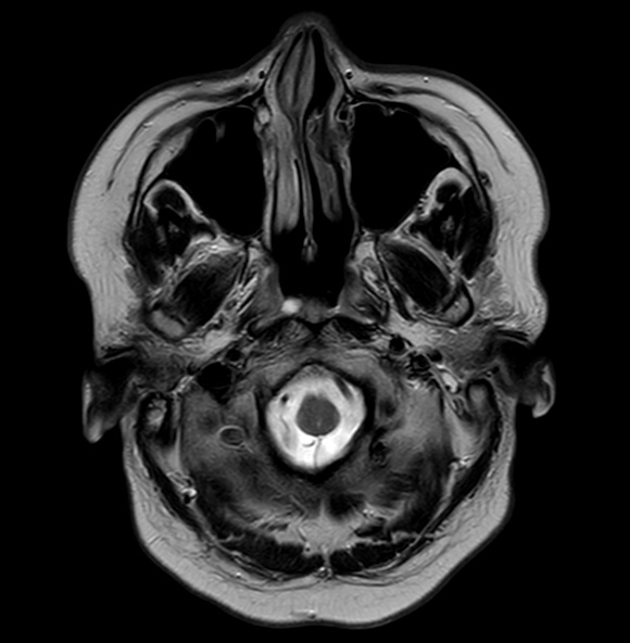 File:Cerebral arteriovenous malformation (Radiopaedia 74411-89343 Axial T2 3).jpg