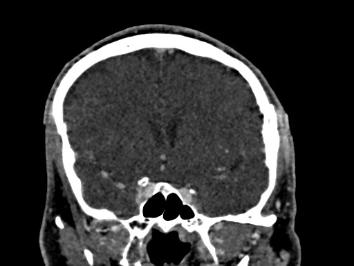 Cerebral arteriovenous malformation (Radiopaedia 78188-90746 Coronal C+ delayed 42).jpg