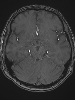 File:Cerebral arteriovenous malformation (Radiopaedia 84015-99245 Axial TOF 104).jpg