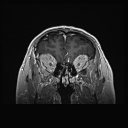 Cerebral arteriovenous malformation (Radiopaedia 84015-99245 Coronal T1 C+ 36).jpg