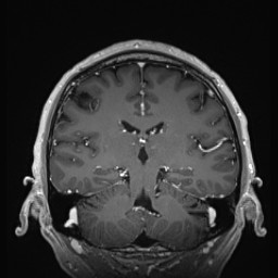 Cerebral arteriovenous malformation (Radiopaedia 84015-99245 Coronal T1 C+ 96).jpg