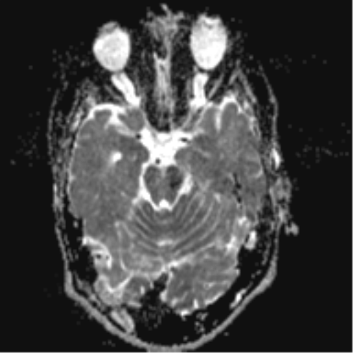 File:Cerebral arteriovenous malformation - huge (Radiopaedia 35734-37272 Axial ADC 8).png