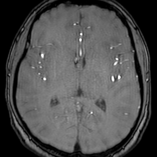 Cerebral arteriovenous malformation at posterior body of corpus callosum (Radiopaedia 74111-84925 Axial MRA 114).jpg