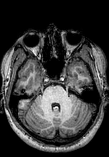 Cerebral arteriovenous malformation at posterior body of corpus callosum (Radiopaedia 74111-84925 Axial T1 226).jpg