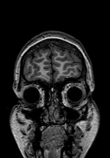 File:Cerebral arteriovenous malformation at posterior body of corpus callosum (Radiopaedia 74111-84925 Coronal T1 14).jpg