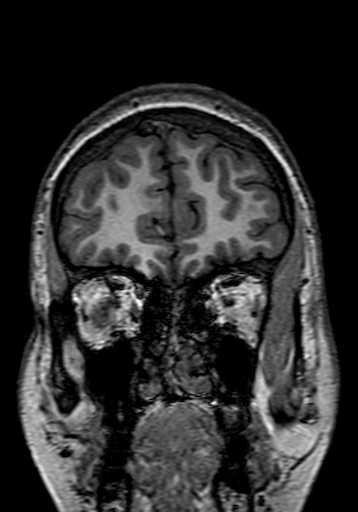 Cerebral arteriovenous malformation at posterior body of corpus callosum (Radiopaedia 74111-84925 Coronal T1 37).jpg