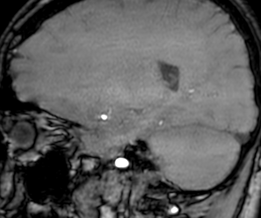 Cerebral arteriovenous malformation at posterior body of corpus callosum (Radiopaedia 74111-84925 J 262).jpg
