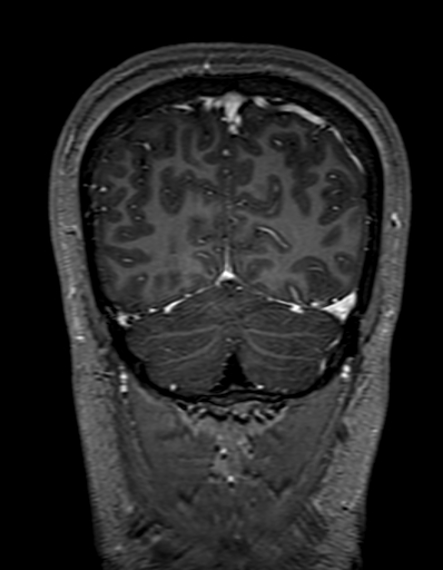 Cerebral arteriovenous malformation at posterior body of corpus callosum (Radiopaedia 74111-84925 K 313).jpg