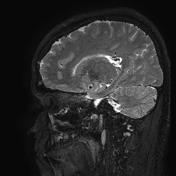 Cerebral arteriovenous malformation at posterior body of corpus callosum (Radiopaedia 74111-84925 Sagittal T2 85).jpg