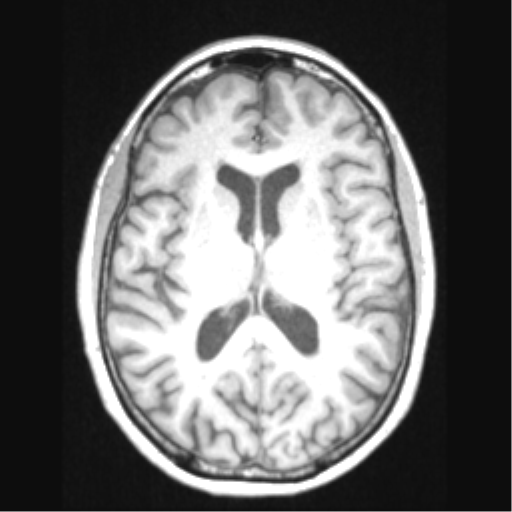 Cerebral arteriovenous malformation with hemorrhage (Radiopaedia 34422-35737 Axial T1 43).png