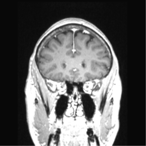 Cerebral arteriovenous malformation with hemorrhage (Radiopaedia 34422-35737 Coronal T1 C+ 68).png