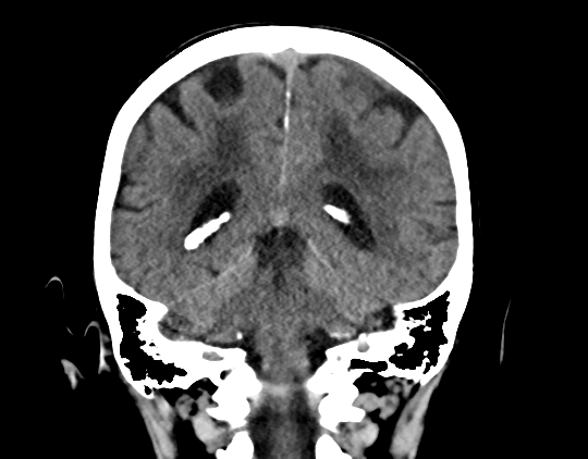 Cerebral arteriovenous malformation with lobar hemorrhage (Radiopaedia 44725-48510 Coronal non-contrast 33).png