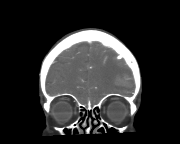 File:Cerebral arteriovenous malformation with lobar hemorrhage (Radiopaedia 44725-48511 A 12).png