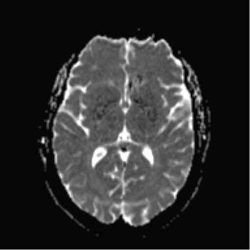 File:Cerebral cavernoma and development venous anomaly (Radiopaedia 37603-39482 Axial ADC 12).png