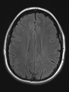 File:Cerebral cavernoma and development venous anomaly (Radiopaedia 37603-39482 Axial FLAIR 15).png