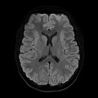 Cerebral cavernous venous malformation (Radiopaedia 70008-80021 Axial DWI 48).jpg