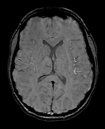 File:Cerebral cavernous venous malformation (Radiopaedia 70008-80021 I 41).jpg