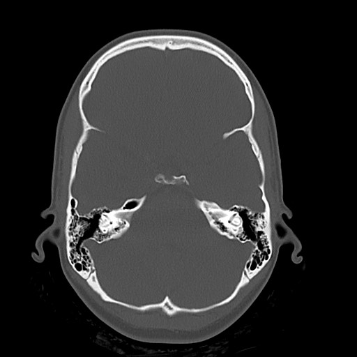 Cerebral cavernous venous malformation (Radiopaedia 70008-80022 Axial bone window 12).jpg