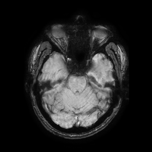 File:Cerebral cavernous venous malformation (Zabramski type II) (Radiopaedia 85511-101198 Axial SWI 47).jpg