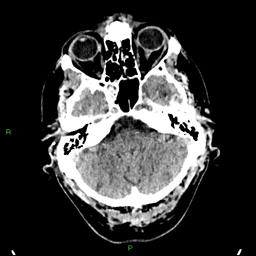 Cerebral contusions (Radiopaedia 33868-35039 Axial non-contrast 42).jpg