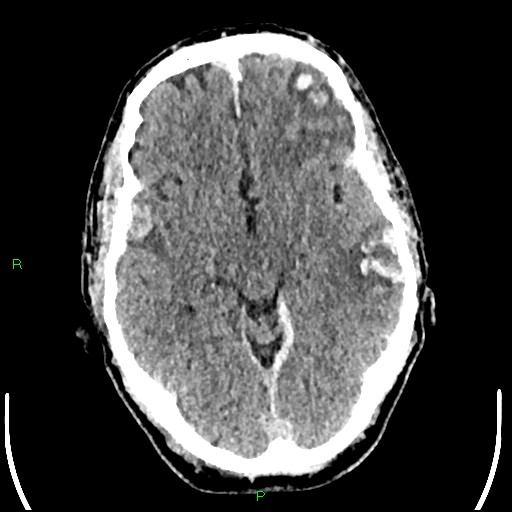Cerebral contusions (Radiopaedia 33868-35039 Axial non-contrast 88).jpg
