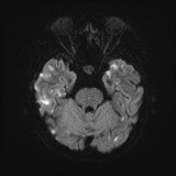 Cerebral embolic infarcts (embolic shower) (Radiopaedia 72391-82921 Axial DWI 39).jpg